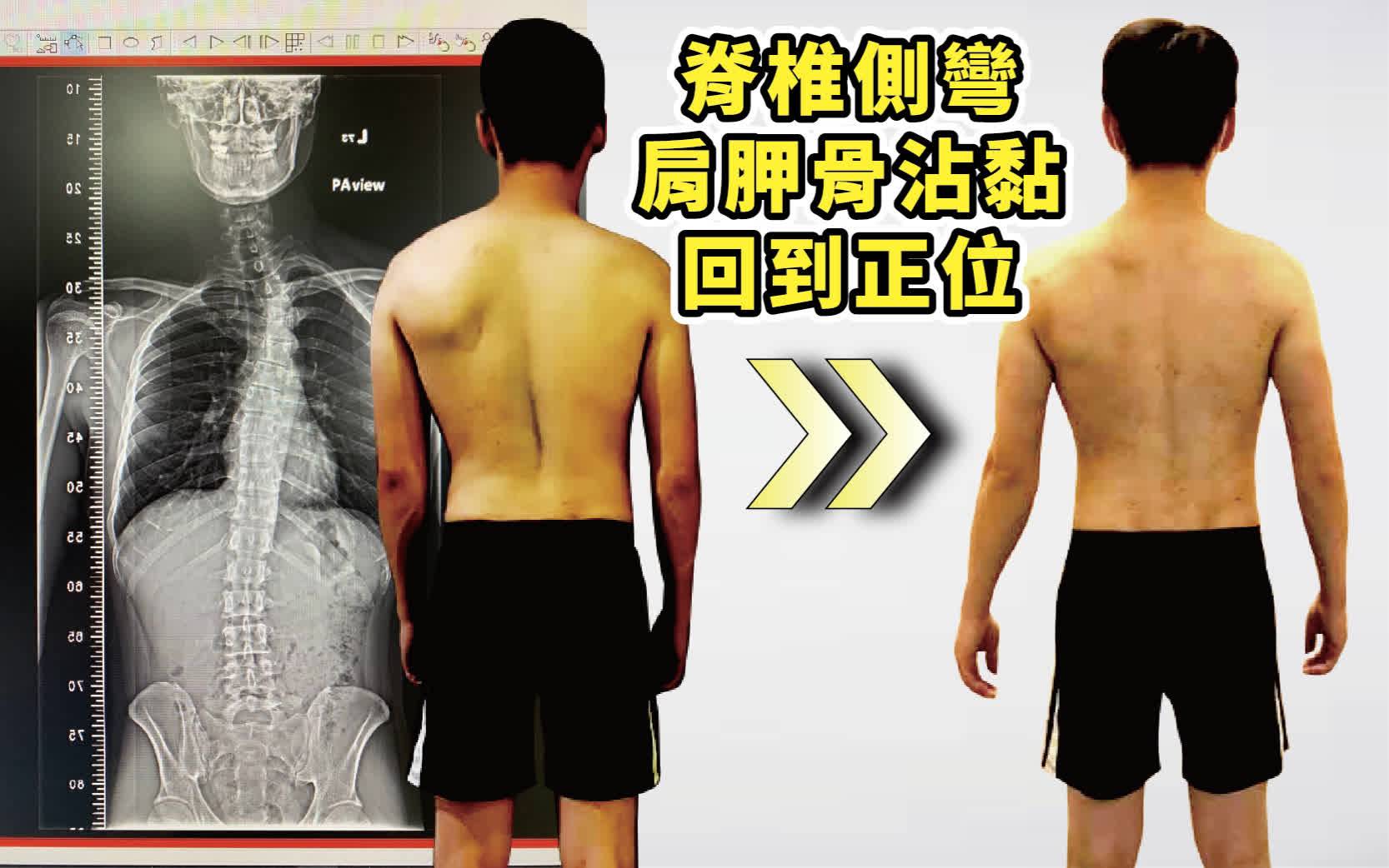脊椎側彎，肩胛骨沾黏回到正位