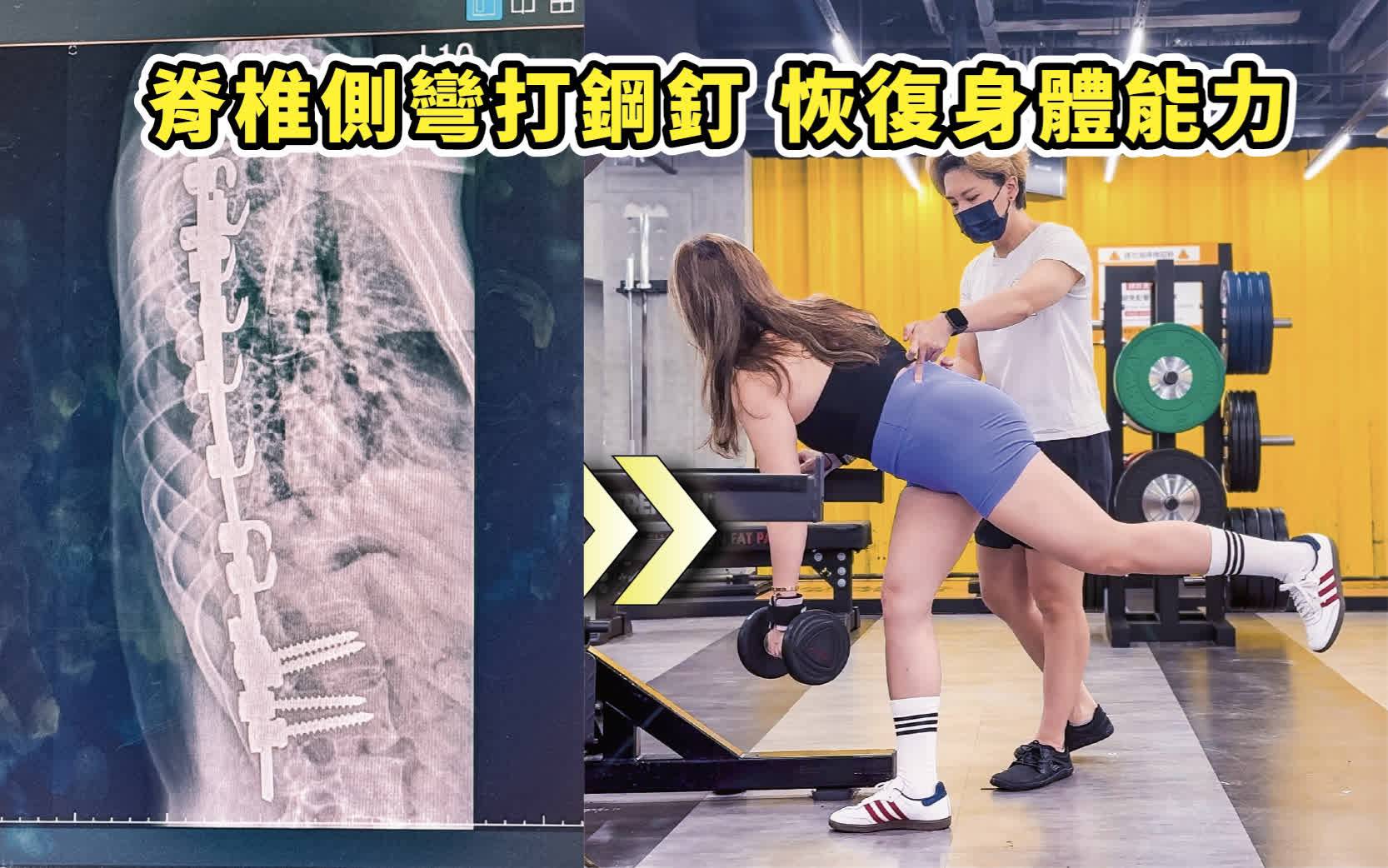脊椎打鋼釘，訓練身體恢復旋轉能力